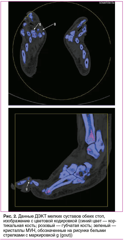 Рис. 2. Данные ДЭКТ мелких суставов обеих стоп, изображение с цветовой кодировкой (синий цвет — кор- тикальная кость; розовый — губчатая кость; зеленый — кристаллы МУН, обозначенные на рисунке белыми стрелками с маркировкой g (gout))