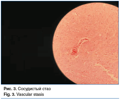 Рис. 3. Сосудистый стаз Fig. 3. Vascular stasis