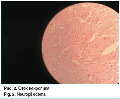 Рис. 2. Отек нейропиля Fig. 2. Neuropil edema