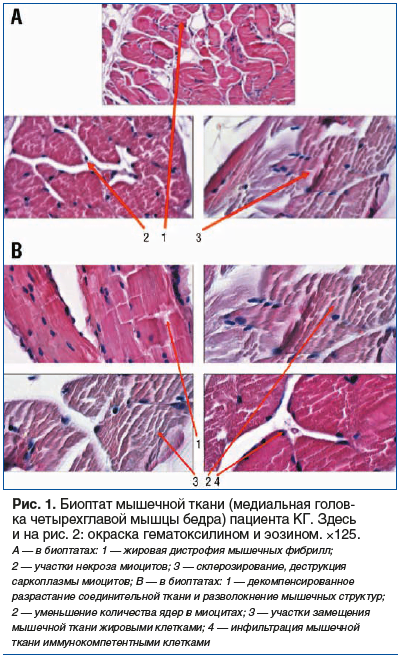 Рис. 1. Биоптат мышечной ткани (медиальная голов- ка четырехглавой мышцы бедра) пациента КГ. Здесь и на рис. 2: окраска гематоксилином и эозином. ×125.