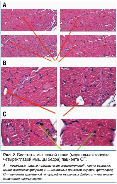 Рис. 2. Биоптаты мышечной ткани (медиальная головка четырехглавой мышцы бедра) пациента ОГ.