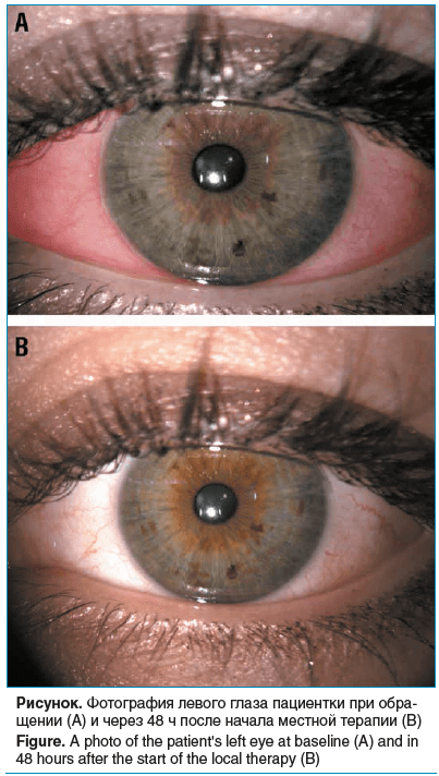 Рисунок. Фотография левого глаза пациентки при обра- щении (А) и через 48 ч после начала местной терапии (B) Figure. A photo of the patient's left eye at baseline (A) and in 48 hours after the start of the local therapy (B)