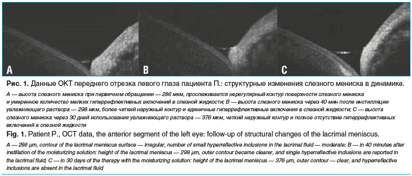 Рис. 1. Данные ОКТ переднего отрезка левого глаза пациента П.: структурные изменения слезного мениска в динамике. А — высота слезного мениска при первичном обращении — 286 мкм, прослеживается нерегулярный контур поверхности слезного мениска и умеренное ко