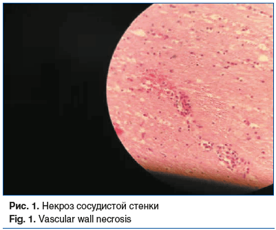 Рис. 1. Некроз сосудистой стенки Fig. 1. Vascular wall necrosis