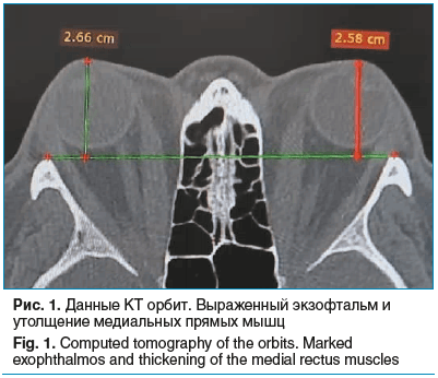 Рис. 1. Данные КТ орбит. Выраженный экзофтальм и утолщение медиальных прямых мышц Fig. 1. Computed tomography of the orbits. Marked exophthalmos and thickening of the medial rectus muscles