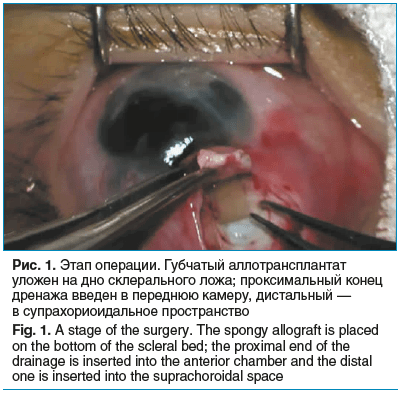 Рис. 1. Этап операции. Губчатый аллотрансплантат уложен на дно склерального ложа; проксимальный конец дренажа введен в переднюю камеру, дистальный — в супрахориоидальное пространство Fig. 1. A stage of the surgery. The spongy allograft is placed on the bo Рис. 1. Этап операции. Губчатый аллотрансплантат уложен на дно склерального ложа; проксимальный конец дренажа введен в переднюю камеру, дистальный — в супрахориоидальное пространство Fig. 1. A stage of the surgery. The spongy allograft is placed on the bo