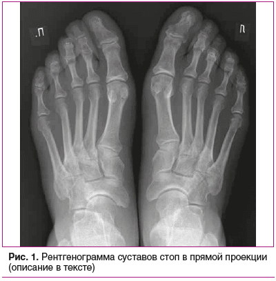 Рис. 1. Рентгенограмма суставов стоп в прямой проекции (описание в тексте)