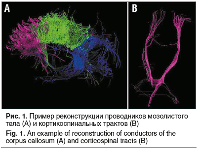 Рис. 1. Пример реконструкции проводников мозолистого тела (А) и кортикоспинальных трактов (В) Fig. 1. An example of reconstruction of conductors of the corpus callosum (A) and corticospinal tracts (B)