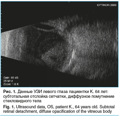 Рис. 1. Данные УЗИ левого глаза пациентки К. 64 лет: субтотальная отслойка сетчатки, диффузное помутнение стекловидного тела Fig. 1. Ultrasound data, OS, patient K., 64 years old. Subtotal retinal detachment, diffuse opacification of the vitreous body