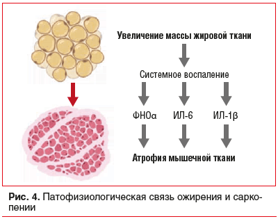 Рис. 4. Патофизиологическая связь ожирения и саркопении
