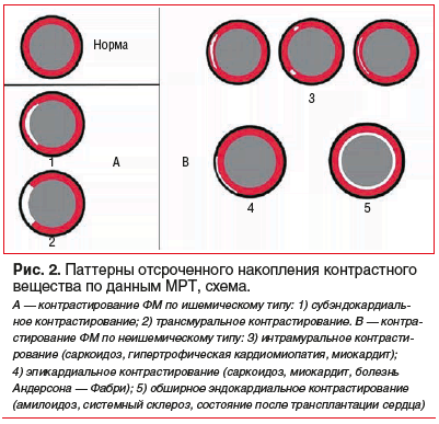 Рис. 2. Паттерны отсроченного накопления контрастного вещества по данным МРТ, схема