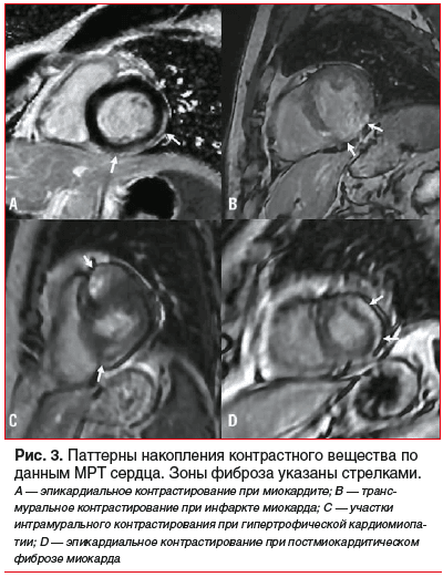 Рис. 3. Паттерны накопления контрастного вещества по данным МРТ сердца. Зоны фиброза указаны стрелками