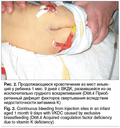 Рис. 2. Продолжающееся кровотечение из мест инъек- ций у ребенка 1 мес. 9 дней с ВКДК, развившейся из-за исключительно грудного вскармливания (D68.4 Приоб- ретенный дефицит факторов свертывания вследствие недостаточности витамина К) Fig. 2. Continuous ble