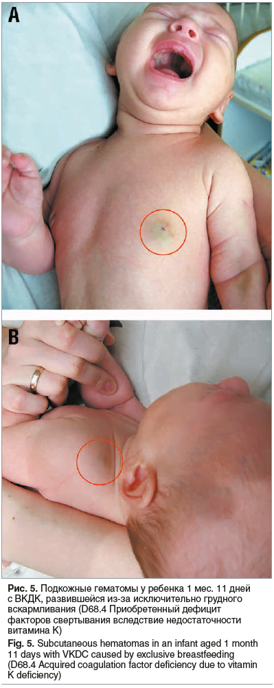 Рис. 5. Подкожные гематомы у ребенка 1 мес. 11 дней с ВКДК, развившейся из-за исключительно грудного вскармливания (D68.4 Приобретенный дефицит факторов свертывания вследствие недостаточности витамина К) Fig. 5. Subcutaneous hematomas in an infant aged 1 