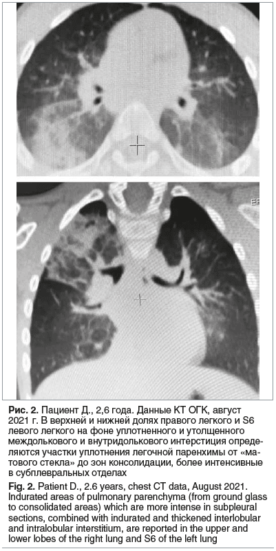 Рис. 2. Пациент Д., 2,6 года. Данные КТ ОГК, август 2021 г. В верхней и нижней долях правого легкого и S6 левого легкого на фоне уплотненного и утолщенного междолькового и внутридолькового интерстиция опреде- ляются участки уплотнения легочной паренхимы о