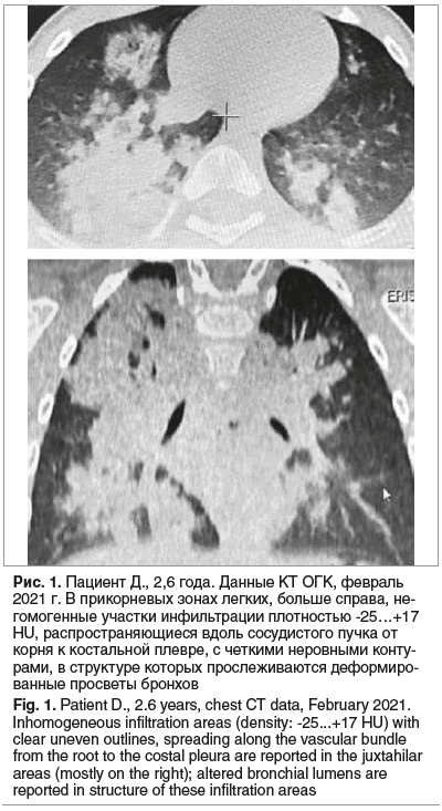 Рис. 1. Пациент Д., 2,6 года. Данные КТ ОГК, февраль 2021 г. В прикорневых зонах легких, больше справа, не- гомогенные участки инфильтрации плотностью -25…+17 HU, распространяющиеся вдоль сосудистого пучка от корня к костальной плевре, с четкими неровными