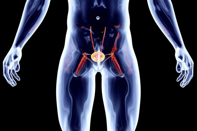 ASCO: воздействие микропластика может быть фактором риска рака простаты
