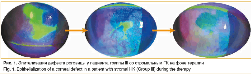 Рис. 1. Эпителизация дефекта роговицы у пациента группы III со стромальным ГК на фоне терапии Fig. 1. Epithelialization of a corneal defect in a patient with stromal HK (Group III) during the therapy Рис. 1. Эпителизация дефекта роговицы у пациента группы III со стромальным ГК на фоне терапии Fig. 1. Epithelialization of a corneal defect in a patient with stromal HK (Group III) during the therapy