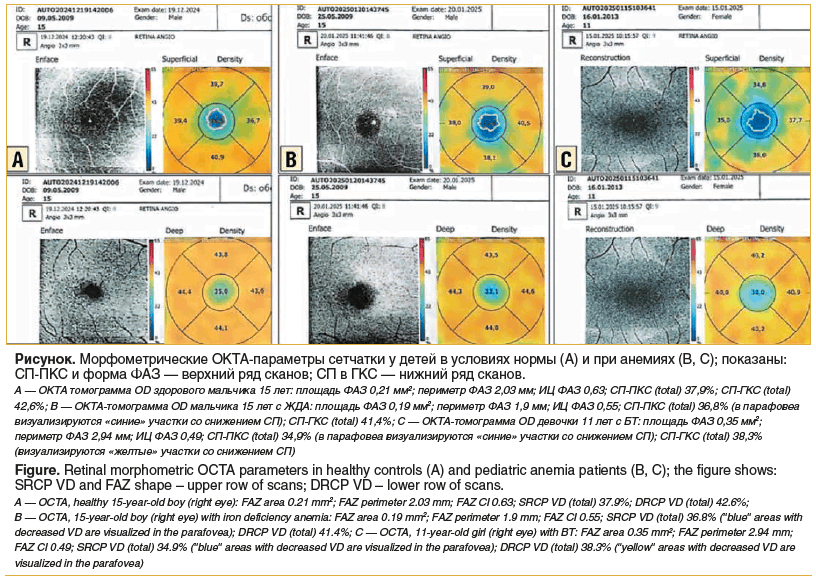 Рисунок. Морфометрические ОКТА-параметры сетчатки у детей в условиях нормы (А) и при анемиях (B, C); показаны: СП-ПКС и форма ФАЗ — верхний ряд сканов; СП в ГКС — нижний ряд сканов. А — ОКТА томограмма OD здорового мальчика 15 лет: площадь ФАЗ 0,21 мм2; п