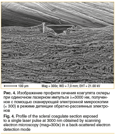 Рис. 4. Изображение профиля сечения коагулята склеры при одиночном лазерном импульсе λ=3000 нм, получен- ное с помощью сканирующей электронной микроскопии (× 300) в режиме детекции обратно-рассеянных электро- нов Fig. 4. Profile of the scleral coagulate s Рис. 4. Изображение профиля сечения коагулята склеры при одиночном лазерном импульсе λ=3000 нм, получен- ное с помощью сканирующей электронной микроскопии (× 300) в режиме детекции обратно-рассеянных электро- нов Fig. 4. Profile of the scleral coagulate s
