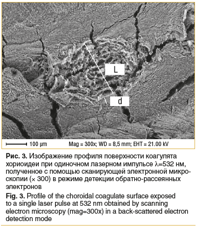 Рис. 3. Изображение профиля поверхности коагулята хориоидеи при одиночном лазерном импульсе λ=532 нм, полученное с помощью сканирующей электронной микро- скопии (× 300) в режиме детекции обратно-рассеянных электронов Fig. 3. Profile of the choroidal coagu Рис. 3. Изображение профиля поверхности коагулята хориоидеи при одиночном лазерном импульсе λ=532 нм, полученное с помощью сканирующей электронной микро- скопии (× 300) в режиме детекции обратно-рассеянных электронов Fig. 3. Profile of the choroidal coagu