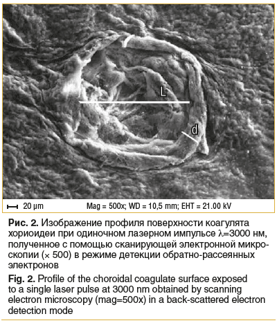 Рис. 2. Изображение профиля поверхности коагулята хориоидеи при одиночном лазерном импульсе λ=3000 нм, полученное с помощью сканирующей электронной микро- скопии (× 500) в режиме детекции обратно-рассеянных электронов Fig. 2. Profile of the choroidal coag Рис. 2. Изображение профиля поверхности коагулята хориоидеи при одиночном лазерном импульсе λ=3000 нм, полученное с помощью сканирующей электронной микро- скопии (× 500) в режиме детекции обратно-рассеянных электронов Fig. 2. Profile of the choroidal coag