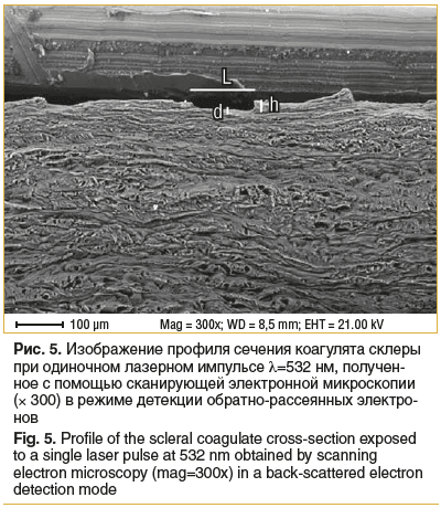 Рис. 5. Изображение профиля сечения коагулята склеры при одиночном лазерном импульсе λ=532 нм, получен- ное с помощью сканирующей электронной микроскопии (× 300) в режиме детекции обратно-рассеянных электро- нов Fig. 5. Profile of the scleral coagulate cr Рис. 5. Изображение профиля сечения коагулята склеры при одиночном лазерном импульсе λ=532 нм, получен- ное с помощью сканирующей электронной микроскопии (× 300) в режиме детекции обратно-рассеянных электро- нов Fig. 5. Profile of the scleral coagulate cr