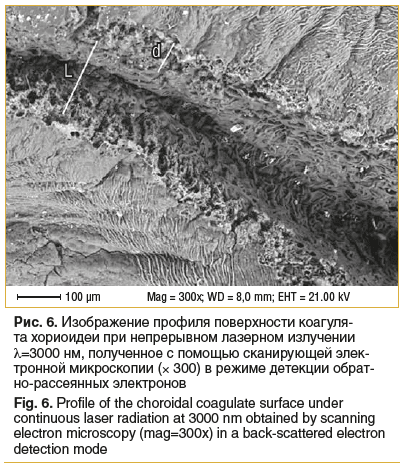 Рис. 6. Изображение профиля поверхности коагуля- та хориоидеи при непрерывном лазерном излучении λ=3000 нм, полученное с помощью сканирующей элек- тронной микроскопии (× 300) в режиме детекции обрат- но-рассеянных электронов Fig. 6. Profile of the choroid Рис. 6. Изображение профиля поверхности коагуля- та хориоидеи при непрерывном лазерном излучении λ=3000 нм, полученное с помощью сканирующей элек- тронной микроскопии (× 300) в режиме детекции обрат- но-рассеянных электронов Fig. 6. Profile of the choroid