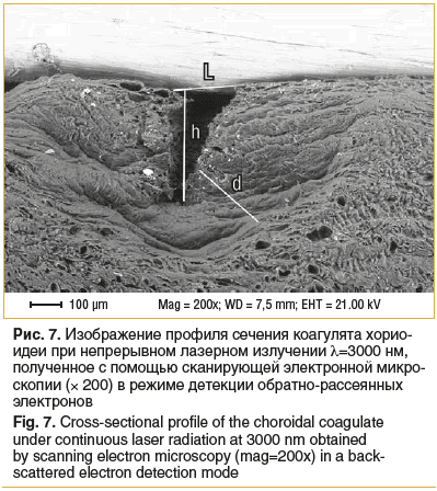 Рис. 7. Изображение профиля сечения коагулята хорио- идеи при непрерывном лазерном излучении λ=3000 нм, полученное с помощью сканирующей электронной микро- скопии (× 200) в режиме детекции обратно-рассеянных электронов Fig. 7. Cross-sectional profile of t Рис. 7. Изображение профиля сечения коагулята хорио- идеи при непрерывном лазерном излучении λ=3000 нм, полученное с помощью сканирующей электронной микро- скопии (× 200) в режиме детекции обратно-рассеянных электронов Fig. 7. Cross-sectional profile of t