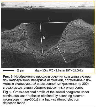 Рис. 9. Изображение профиля сечения коагулята склеры при непрерывном лазерном излучении, полученное с по- мощью сканирующей электронной микроскопии (× 300) в режиме детекции обратно-рассеянных электронов Fig. 9. Cross-sectional profile of the scleral coag Рис. 9. Изображение профиля сечения коагулята склеры при непрерывном лазерном излучении, полученное с по- мощью сканирующей электронной микроскопии (× 300) в режиме детекции обратно-рассеянных электронов Fig. 9. Cross-sectional profile of the scleral coag