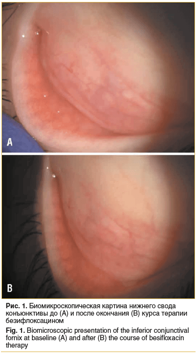 Рис. 1. Биомикроскопическая картина нижнего свода конъюнктивы до (А) и после окончания (B) курса терапии безифлоксацином Fig. 1. Biomicroscopic presentation of the inferior conjunctival fornix at baseline (A) and after (B) the course of besifloxacin thera