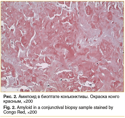 Рис. 2. Амилоид в биоптате конъюнктивы. Окраска конго красным, ×200 Fig. 2. Amyloid in a conjunctival biopsy sample stained by Congo Red, ×200