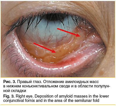Рис. 3. Правый глаз. Отложение амилоидных масс в нижнем конъюнктивальном своде и в области полулун- ной складки Fig. 3. Right eye. Deposition of amyloid masses in the lower conjunctival fornix and in the area of the semilunar fold