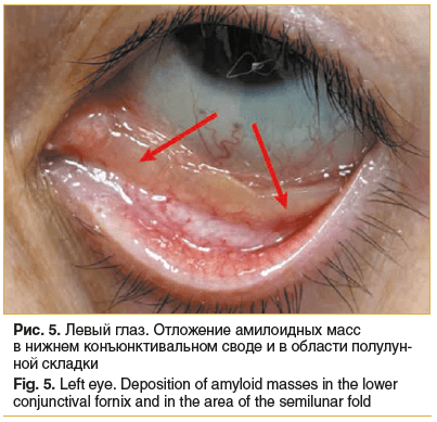 Рис. 5. Левый глаз. Отложение амилоидных масс в нижнем конъюнктивальном своде и в области полулун- ной складки Fig. 5. Left eye. Deposition of amyloid masses in the lower conjunctival fornix and in the area of the semilunar fold