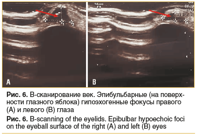 Рис. 6. В-сканирование век. Эпибульбарные (на поверх- ности глазного яблока) гипоэхогенные фокусы правого (А) и левого (В) глаза Рис. 6. B-scanning of the eyelids. Epibulbar hypoechoic foci on the eyeball surface of the right (A) and left (B) eyes