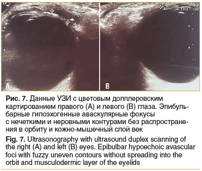 Рис. 7. Данные УЗИ с цветовым допплеровским картированием правого (А) и левого (В) глаза. Эпибуль- барные гипоэхогенные аваскулярные фокусы с нечеткими и неровными контурами без распростране- ния в орбиту и кожно-мышечный слой век Fig. 7. Ultrasonography 
