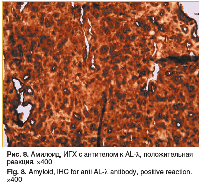 Рис. 8. Амилоид, ИГХ с антителом к AL-λ, положительная реакция. ×400 Fig. 8. Amyloid, IHC for anti AL-λ antibody, positive reaction. ×400