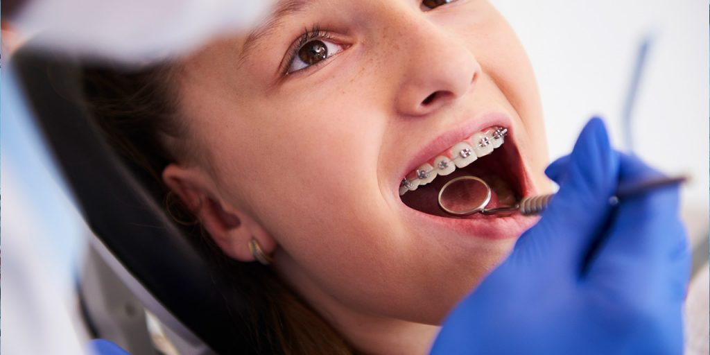 Врач предупредила о последствиях неправильно установленных брекетов