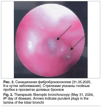 Рис. 2. Санационная фибробронхоскопия (31.05.2025, 8-е сутки заболевания). Стрелками указаны гнойные пробки в просветах долевых бронхов Fig. 2. Therapeutic fiberoptic bronchoscopy (May 31, 2024, 8th day of disease). Arrows indicate purulent plugs in the l