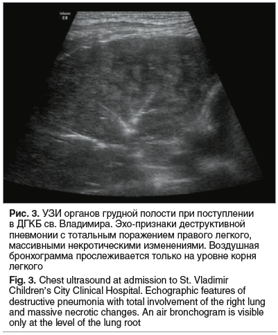 Рис. 3. УЗИ органов грудной полости при поступлении в ДГКБ св. Владимира. Эхо-признаки деструктивной пневмонии с тотальным поражением правого легкого, массивными некротическими изменениями. Воздушная бронхограмма прослеживается только на уровне корня легк