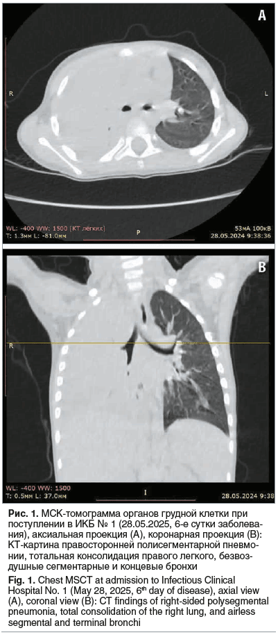 Рис. 1. МСК-томограмма органов грудной клетки при поступлении в ИКБ № 1 (28.05.2025, 6-е сутки заболева- ния), аксиальная проекция (А), коронарная проекция (В): КТ-картина правосторонней полисегментарной пневмо- нии, тотальная консолидация правого легкого