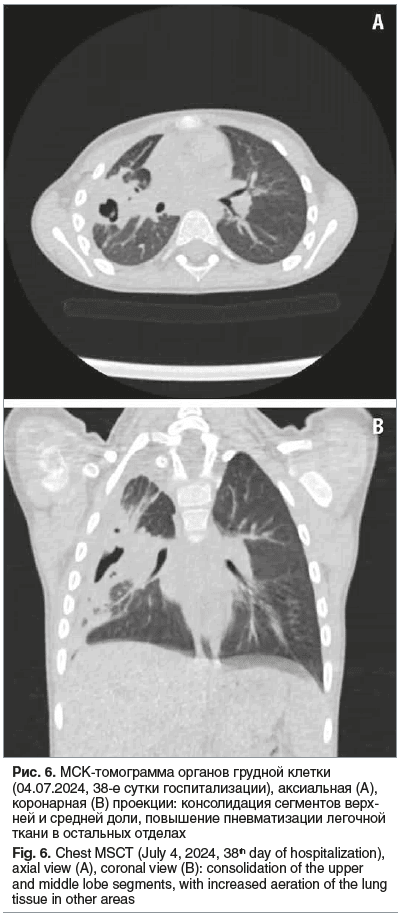 Рис. 6. МСК-томограмма органов грудной клетки (04.07.2024, 38-е сутки госпитализации), аксиальная (А), коронарная (В) проекции: консолидация сегментов верх- ней и средней доли, повышение пневматизации легочной ткани в остальных отделах Fig. 6. Chest MSCT 