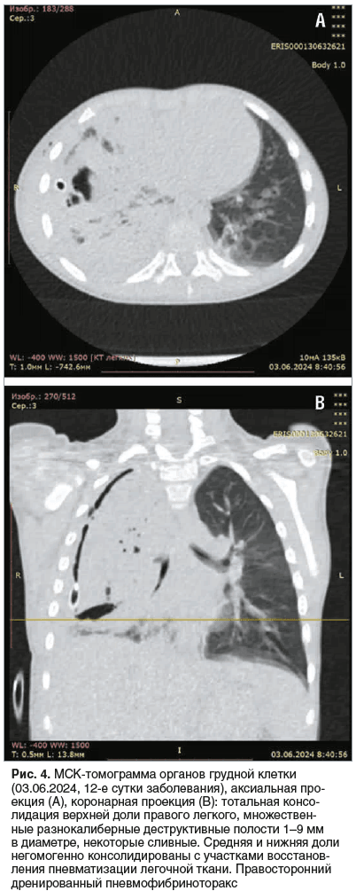 Рис. 4. МСК-томограмма органов грудной клетки (03.06.2024, 12-е сутки заболевания), аксиальная про- екция (А), коронарная проекция (В): тотальная консо- лидация верхней доли правого легкого, множествен- ные разнокалиберные деструктивные полости 1–9 мм в д