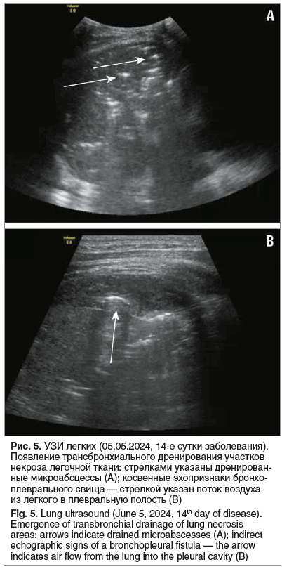 Рис. 5. УЗИ легких (05.05.2024, 14-е сутки заболевания). Появление трансбронхиального дренирования участков некроза легочной ткани: стрелками указаны дренирован- ные микроабсцессы (А); косвенные эхопризнаки бронхо- плеврального свища — стрелкой указан пот