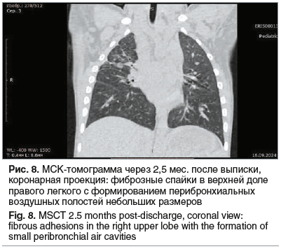 Рис. 8. МСК-томограмма через 2,5 мес. после выписки, коронарная проекция: фиброзные спайки в верхней доле правого легкого с формированием перибронхиальных воздушных полостей небольших размеров Fig. 8. MSCT 2.5 months post-discharge, coronal view: fibrous 