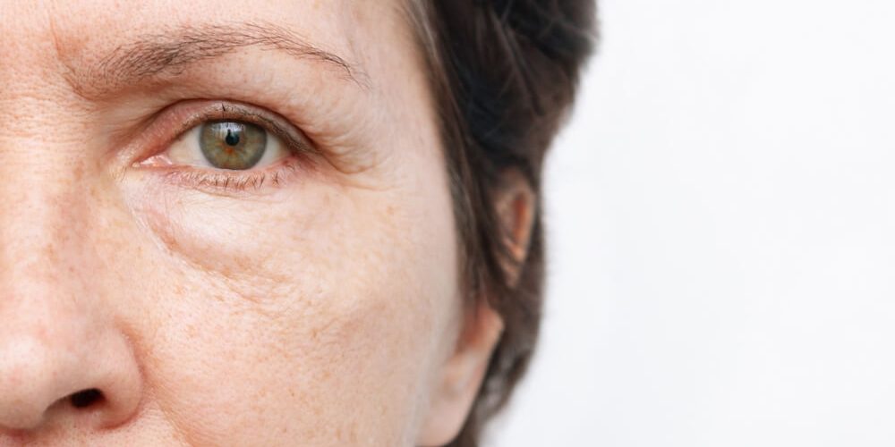 Врач Заручаева: теплый и рыхлый отек век с утра может