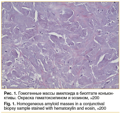 Рис. 1. Гомогенные массы амилоида в биоптате конъюн- ктивы. Окраска гематоксилином и эозином, ×200 Fig. 1. Homogeneous amyloid masses in a conjunctival biopsy sample stained with hematoxylin and eosin, ×200