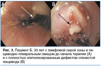Рис. 3. Пациент Б. 33 лет с лимфомой серой зоны и пи- щеводно-плевральным свищом до начала терапии (А) и с полностью эпителизированным дефектом слизистой пищевода (B) Рис. 3. Пациент Б. 33 лет с лимфомой серой зоны и пи- щеводно-плевральным свищом до начала терапии (А) и с полностью эпителизированным дефектом слизистой пищевода (B)