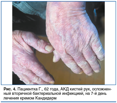 Рис. 4. Пациентка Г., 62 года, АКД кистей рук, осложнен- ный вторичной бактериальной инфекцией, на 7-й день лечения кремом Кандидерм Рис. 4. Пациентка Г., 62 года, АКД кистей рук, осложнен- ный вторичной бактериальной инфекцией, на 7-й день лечения кремом Кандидерм
