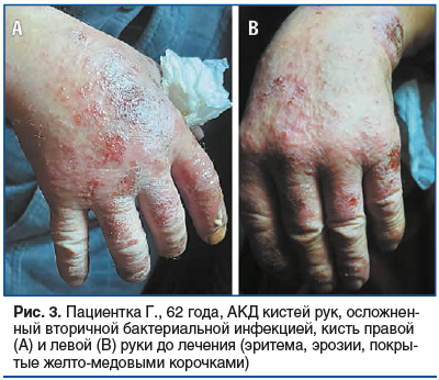 Рис. 3. Пациентка Г., 62 года, АКД кистей рук, осложнен- ный вторичной бактериальной инфекцией, кисть правой (А) и левой (В) руки до лечения (эритема, эрозии, покрытые желто-медовыми корочками) Рис. 3. Пациентка Г., 62 года, АКД кистей рук, осложнен- ный вторичной бактериальной инфекцией, кисть правой (А) и левой (В) руки до лечения (эритема, эрозии, покрытые желто-медовыми корочками)
